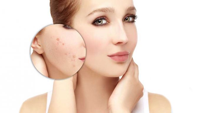 Стоит ли удалять угревую сыпь лазером?